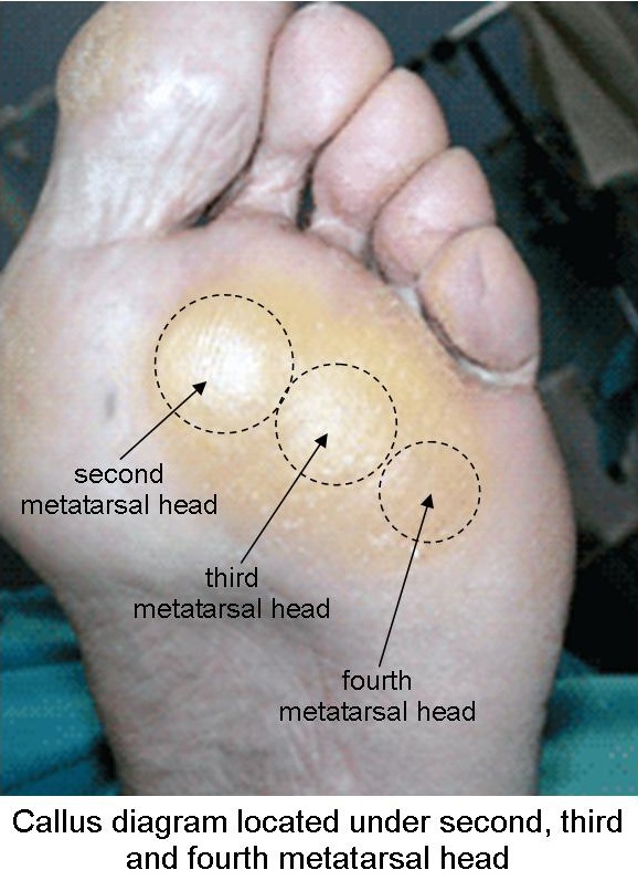 Can Calluses Cause Foot Pain